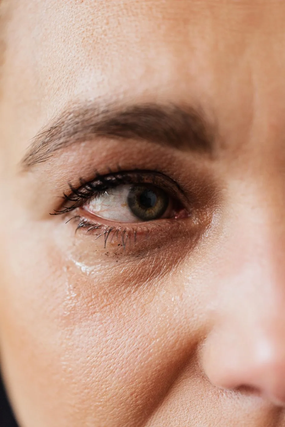 Müdes Auge mit Tränenfurche und Schatten in der Unterlidregion