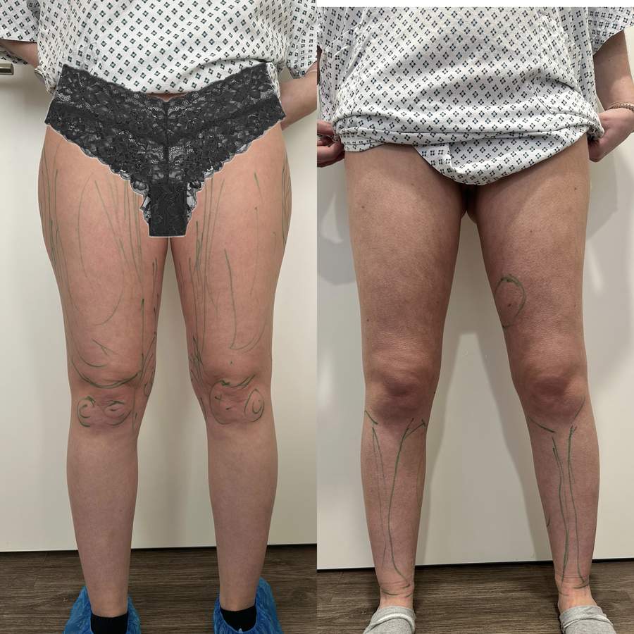 Fettabsaugung Ergebnis Vorher — Body Art Surgery Düsseldorf