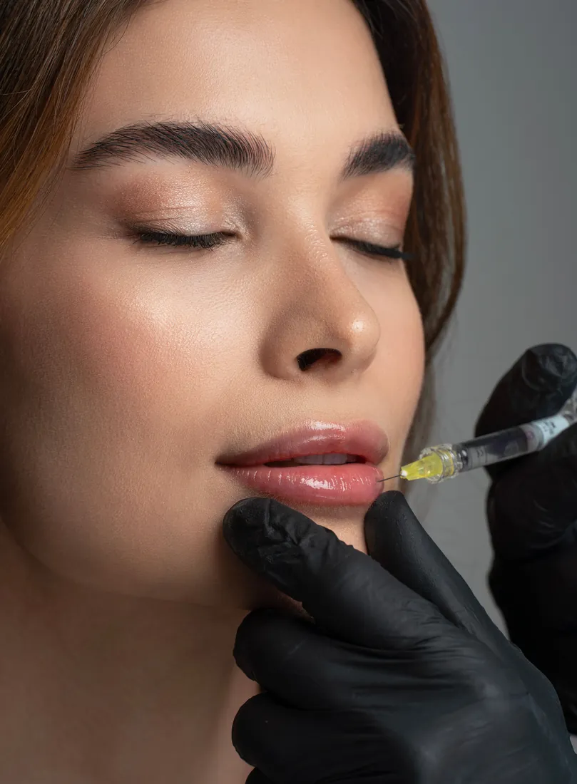 Lippenfiller mit Hyaluron beim Facharzt in Düsseldorf — natürliche Lippen