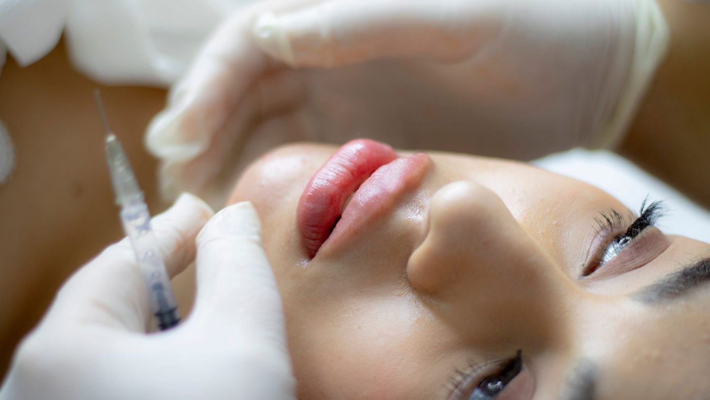 Hyaluron-Filler-Behandlung der Lippen – Ablauf der Unterspritzung in Düsseldorf