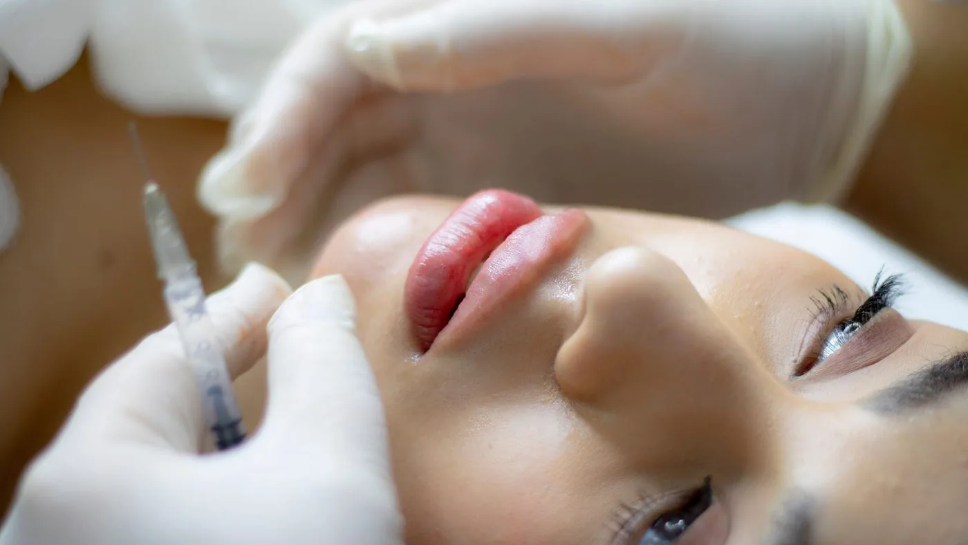 Hyaluron-Filler-Behandlung der Lippen – Ablauf der Unterspritzung in Düsseldorf