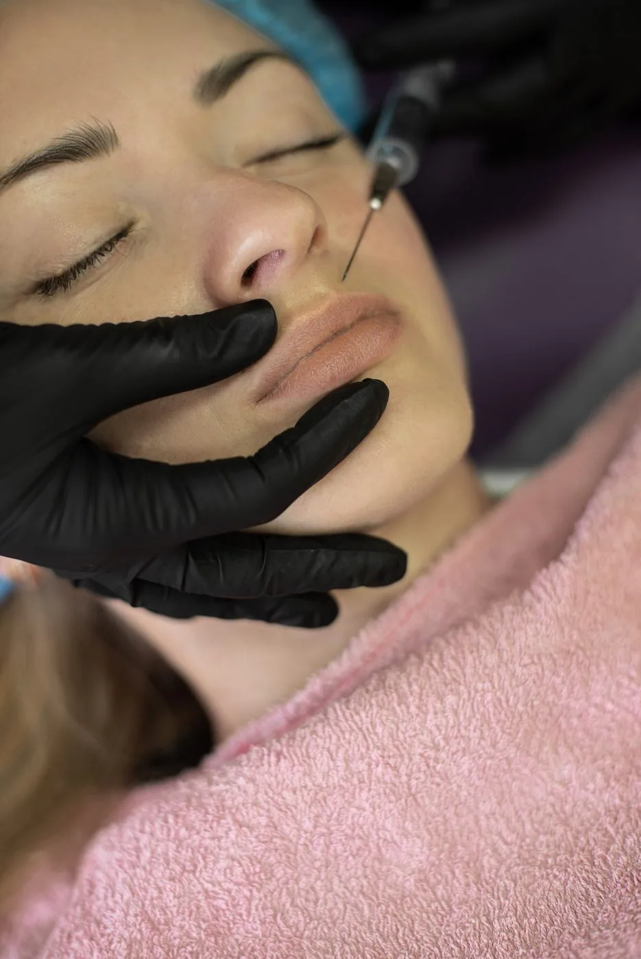 Lippenunterspritzung in der Praxis – präzise Injektion mit feiner Nadel