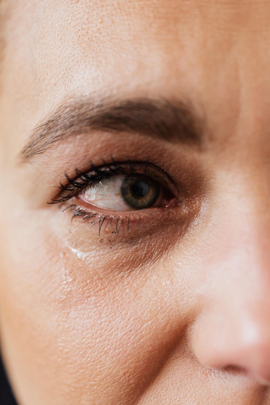 Müdes Auge mit Tränenfurche und Schatten in der Unterlidregion